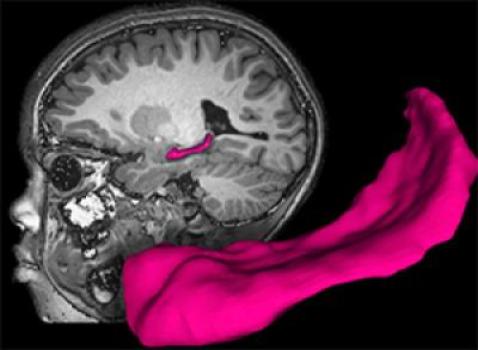 MRI of child's brain featuring hippocampus